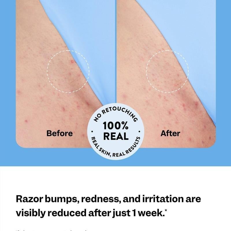🎁🔥 Ingrown Hair Treatment – Glide Your Way to Silky-Smooth, Bump-Free Skin🌟